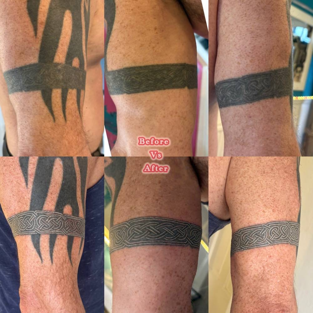 Armband cover-up before and after, by Moll